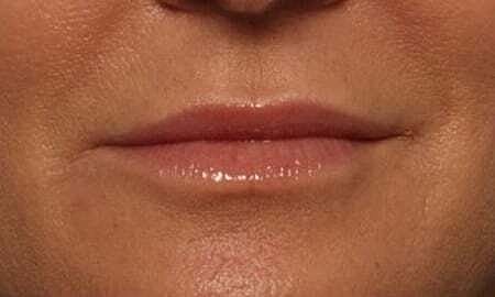 Lip Filler Before & After