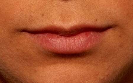 Lip Filler Before & After