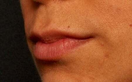 Lip Filler Before & After