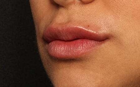 Lip Filler Before & After