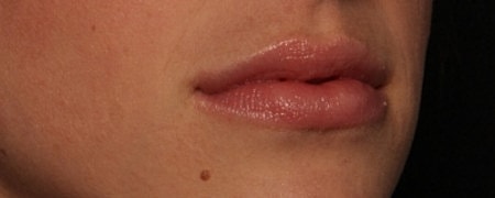 Lip Filler Before & After