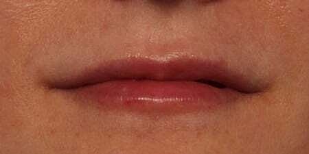 Lip Filler Before & After