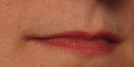 Lip Filler Before & After