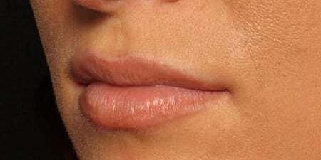 Lip Filler Before & After