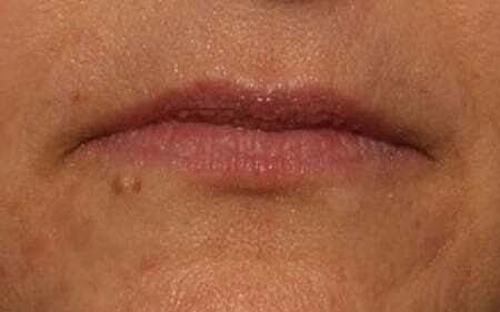 Lip Filler Before & After