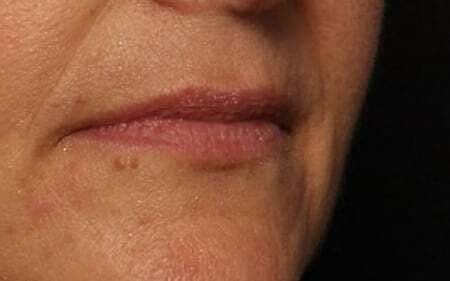 Lip Filler Before & After