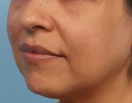 Before and After Lutronic Hollywood Spectra