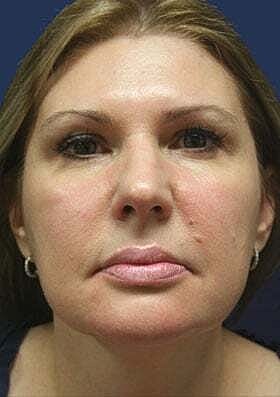 Neck Lift Before & After