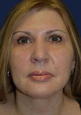 Neck Lift Before & After