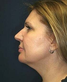 Neck Lift Before & After