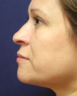 Neck Lift Before & After