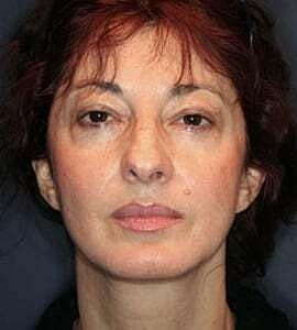 Neck Lift Before & After