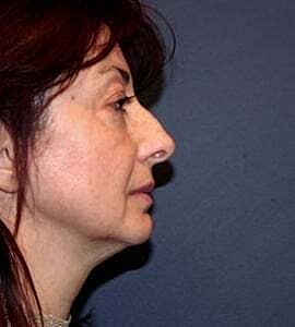 Neck Lift Before & After