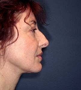 Neck Lift Before & After
