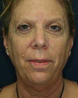 Neck Lift Before & After