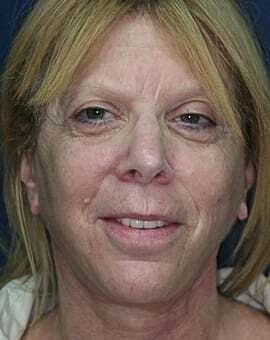 Neck Lift Before & After