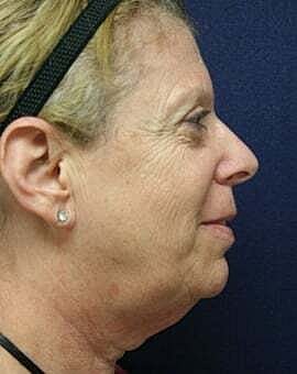 Neck Lift Before & After