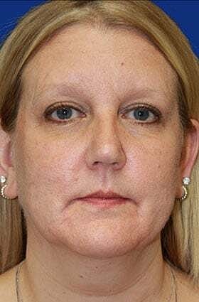 Neck Lift Before & After