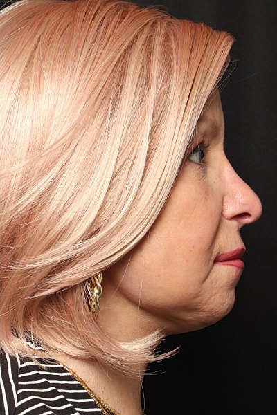 Neck Lift Before & After
