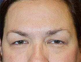 Blepharoplasty Before & After