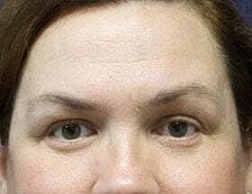 Blepharoplasty Before & After