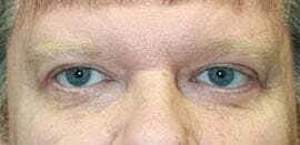 Blepharoplasty Before & After