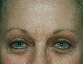 Blepharoplasty Before & After
