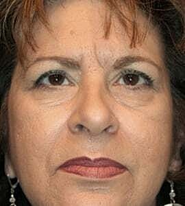 Blepharoplasty Before & After