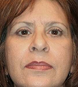 Blepharoplasty Before & After