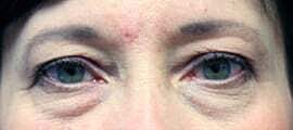 Blepharoplasty Before & After