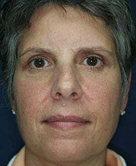 Blepharoplasty Before & After