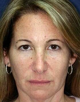 Blepharoplasty Before & After