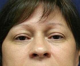 Blepharoplasty Before & After