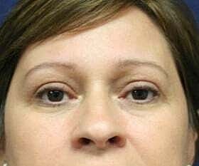 Blepharoplasty Before & After
