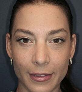 Blepharoplasty Before & After