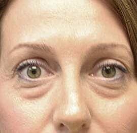 Blepharoplasty Before & After