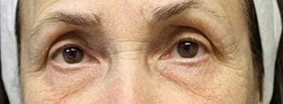 Blepharoplasty Before & After