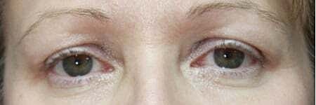 Blepharoplasty Before & After