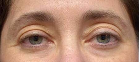 Blepharoplasty Before & After