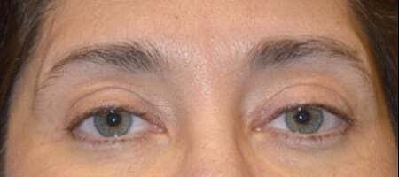 Blepharoplasty Before & After