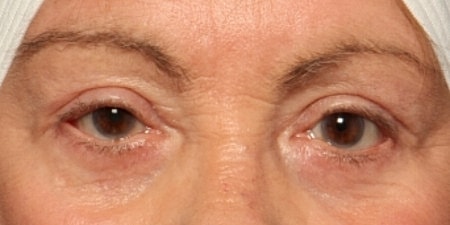 Blepharoplasty Before & After