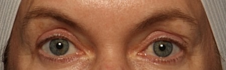 Blepharoplasty Before & After