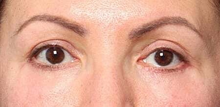 Blepharoplasty Before & After