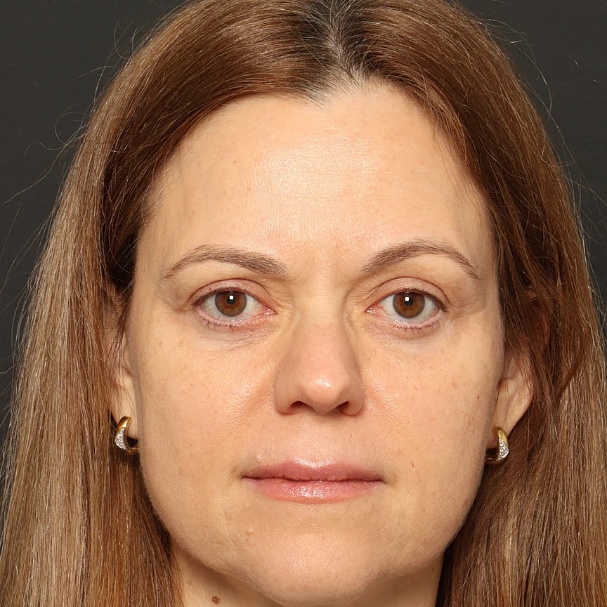 Blepharoplasty Before & After