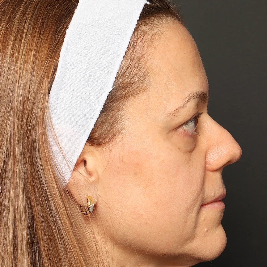 Blepharoplasty Before & After