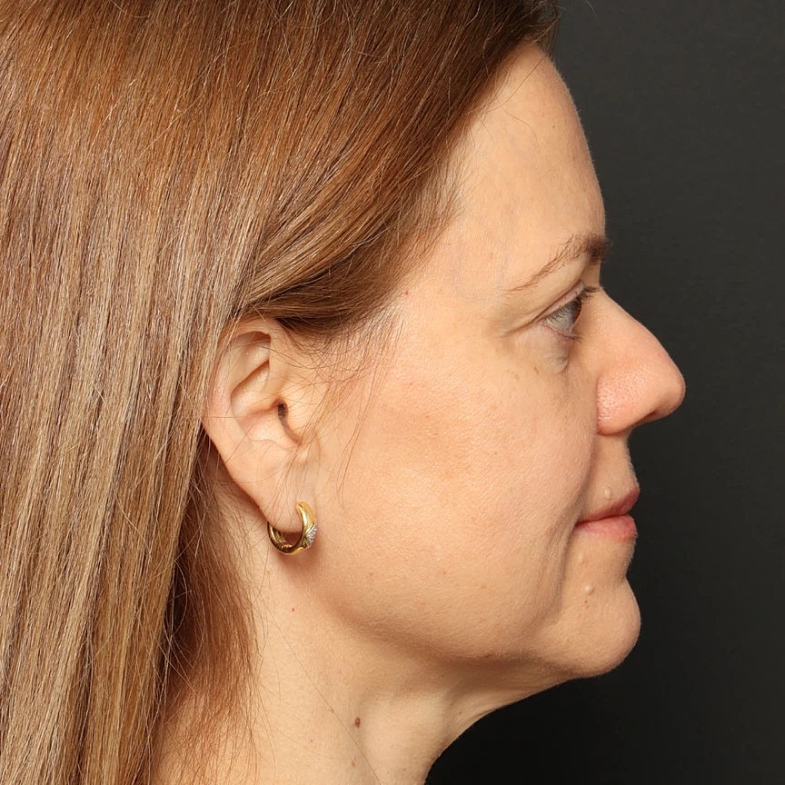 Blepharoplasty Before & After