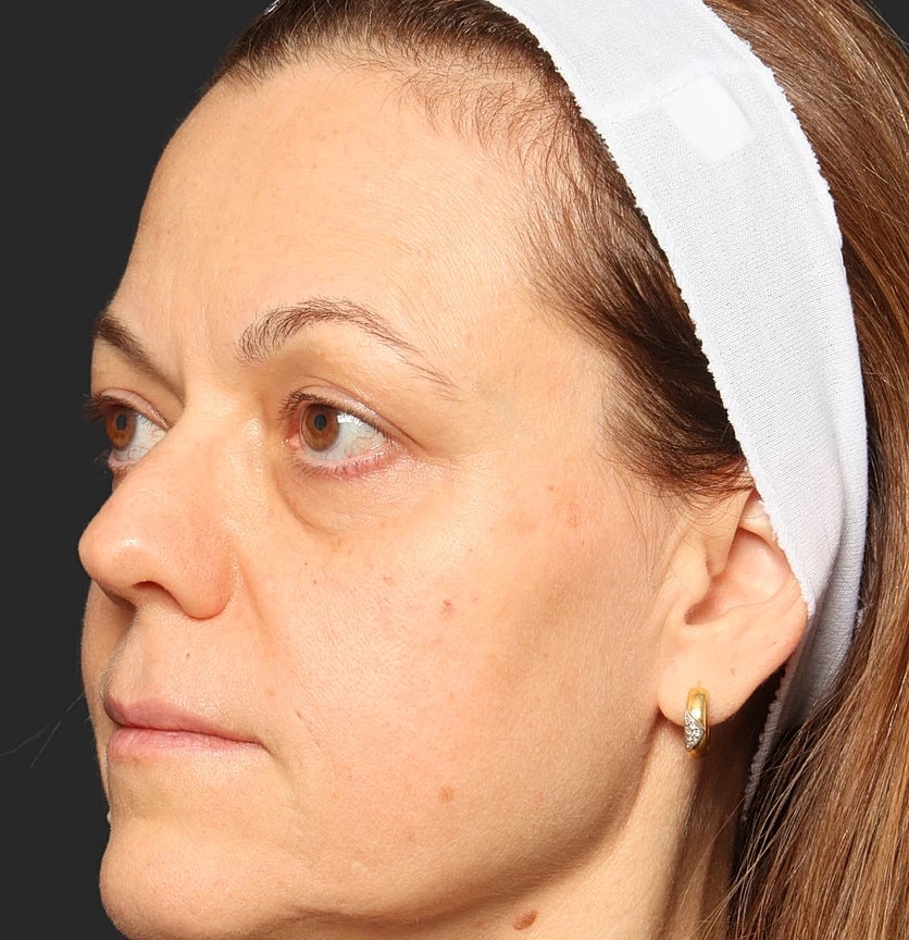 Blepharoplasty Before & After