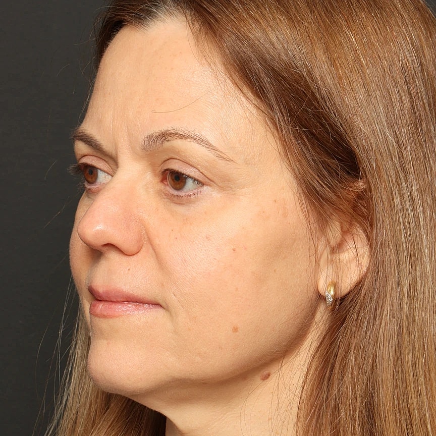 Blepharoplasty Before & After