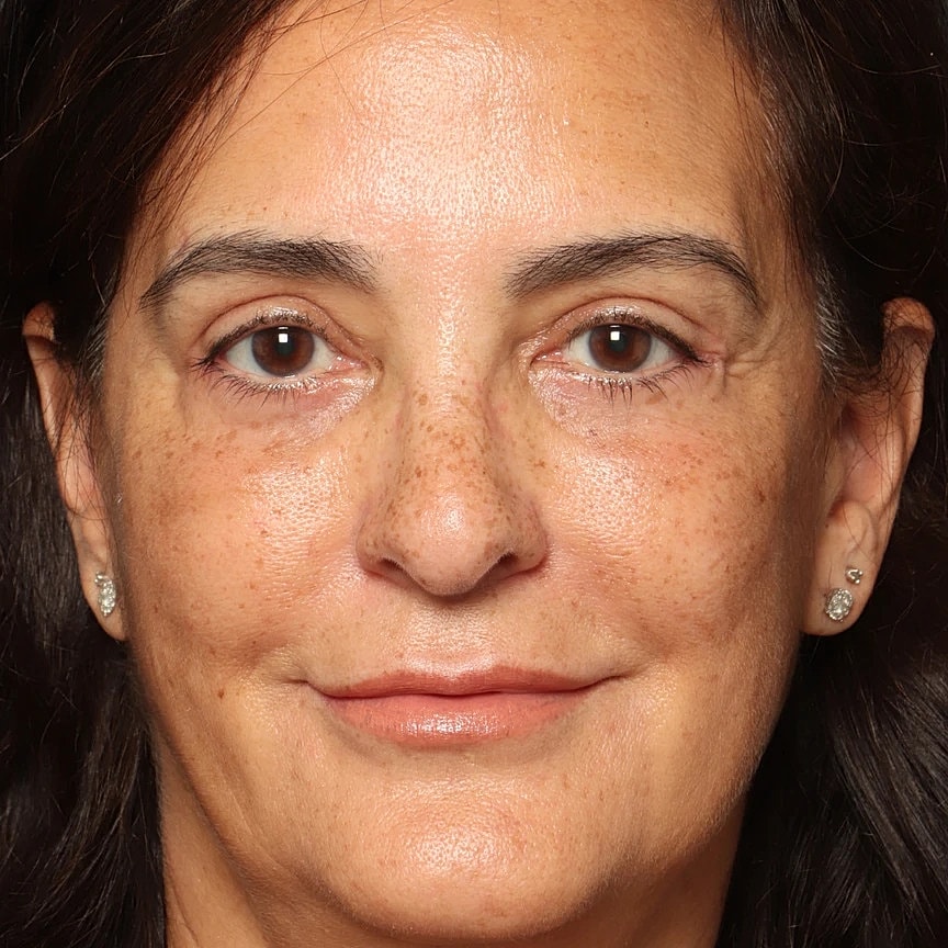 Blepharoplasty Before & After