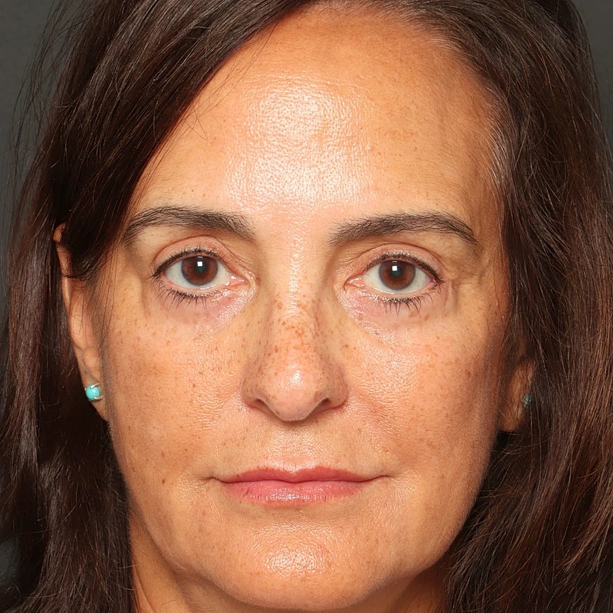 Blepharoplasty Before & After
